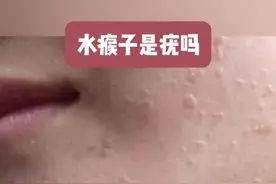 水瘊子是疣吗？ #医学科普 #科普一下 #瘊子 #水瘊子 #dou是知识视频封面