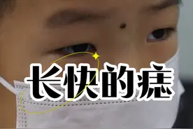 对于快速增长的痣应该如何处理？#黑痣#医疗健康创作训练营 #硬核健康科普行动  #刘新海医生 #黑痣切除视频封面