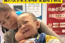 脸上、胸前、后背……#6岁男孩患兽皮痣全身到处埋扩张器 ，晨宝妈妈：我们一家人从黑龙江来到北京治病，为了把他身上的黑色皮肤换掉，目前做了17次手术，花费了100多万。（来源：@小晨宇成长记（逆袭中） ）