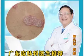 得了牛皮癣以后能根治吗？银屑病这几点让你少走弯路 #皮肤问题 #硬核健康科普行动 #广东银屑病医生推荐 #单孔荣医生 #银屑病视频封面