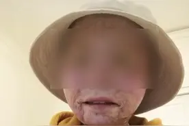 24岁女孩烧伤928天后的重生：“折翼”女孩讲述被噩梦洗礼后的人生视频封面