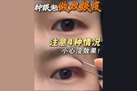 肿眼泡做双眼皮，做好4点，自然又持久！ #丁志双眼皮  #双眼皮手术   #自然双眼皮  #肿眼泡  #全切双眼皮视频封面