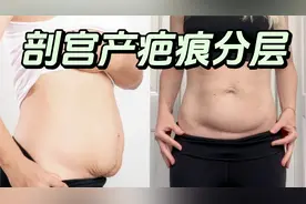 【剖腹产疤痕】肚子分层必备｜松解深层粘连
