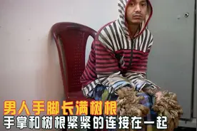 男人手脚长满树根，手掌和树根紧紧的连在一起，被称树根人