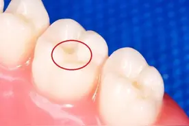 每一颗出现「黑线」的牙齿，可能早“别有洞天”了图片