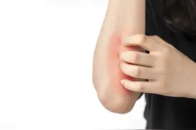 再严重的皮肤病，也害怕这四种中成药 皮炎、湿疹、荨麻疹皆可用图片