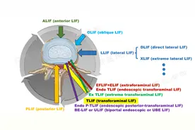 UBE/BESS下腰椎融合术的种类、溯源及对比（上）图片