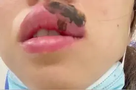 女子睡梦中被蜈蚣咬醒成“香肠嘴”，当事人：几秒钟嘴巴就肿起来了，超乎想象的疼，还有些胸闷图片