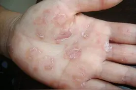 有过高危性行为后，做什么检查筛查梅毒图片