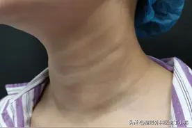 女士填充了假玻尿酸，天鹅颈变火鸡脖！脖颈鼓包凸起怎么办？图片
