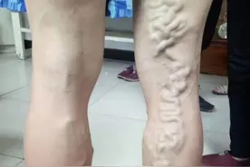 静脉曲张的六大常见症状！医生：建议收藏图片