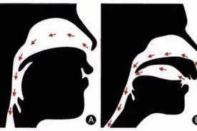 “张嘴呼吸”竟让孩子越来越丑，医生说这样还有救图片