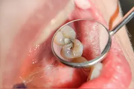 牙齿酸软无力，请小心这些牙病图片