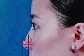 鼻部整形｜鼻头圆钝、扁趴，好看的鼻尖是这么手术来的图片