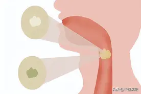 肝郁也会导致痰湿？治痰先治气，气顺痰自消！教你从肝消除痰湿图片