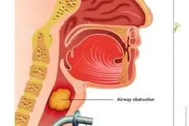 当家属被问及“要不要气管切开？”都会不知所措，怎么抉择？图片