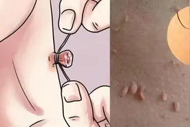 皮肤长“小肉球”是怎么回事，可以抠掉吗？该如何去除？望知晓图片