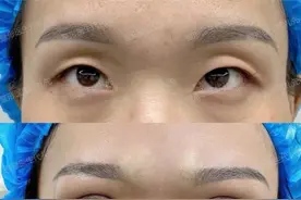 43岁做了眼窝凹陷填充+全切双眼皮，术后眼睛的变化太大了图片