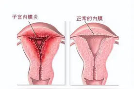 子宫内膜炎，女性难以启齿的痛！这张方子，消炎止痛，祛瘀生新图片