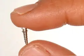 为什么牙齿矫正还要“打钉子”？到底疼不疼？一文读懂！图片