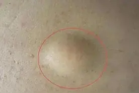 腰部长了一个包，摸着软软的，不疼不痒，是什么东西？图片