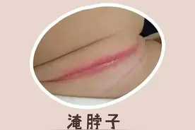 宝宝“淹脖子”了，脖子那里红红的，该怎么办呀？图片