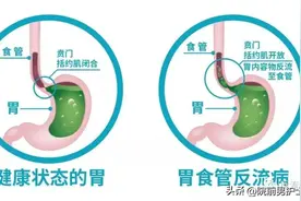关于反流性食管炎的诊疗措施图片