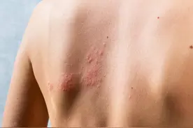 坊间的“蛇缠腰”到底是什么病？绕一圈真的就没命了？图片