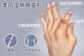 手指关节疼痛、肿胀、变形？记住这3点，恢复日常功能图片