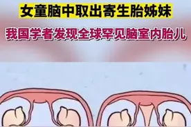 惊!一岁女童脑中竟有寄生双胞胎姊妹!图片