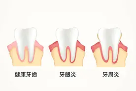 为什么牙科很少来治牙周炎的患者？图片