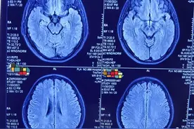 30岁女子右下肢麻木，多次治疗无效，被细心老专家查出原因图片
