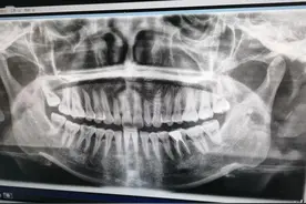 500与大几千的全瓷牙冠区别在哪里图片