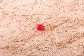 皮肤出现“小红点”是怎么回事？或与6个因素有关，需警惕！图片