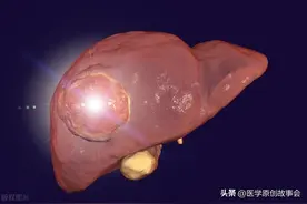 肝癌：从确诊到死亡仅仅6个月！五个症状，可能是肝脏在求救图片