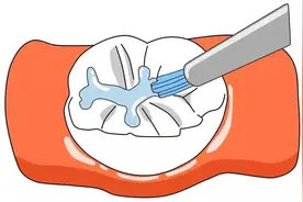 窝沟封闭，为孩子的牙齿穿上“保护衣”图片