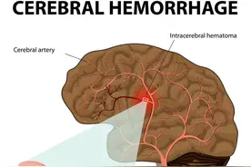 脑出血来临并非“不声不响”，身体出现这5个“预警”，别忽视了图片