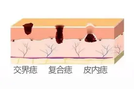 有“痣”之士，如何斗“痣”？图片