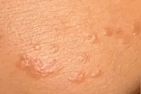 不容忽视的小问题——扁平疣图片