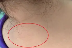 富贵包您了解多少？李医生给您来说图片