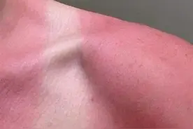 海边玩水因防晒没做到位，一家三口被晒成“小红人”图片