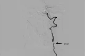 漂流归来，武汉女子竟突发脑“中风”险丢命图片