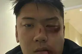 崔晋被人打了？晒出自己鼻青脸肿照片，粉丝纷纷投来关怀声音图片