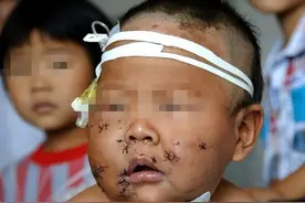 因吃奶太用力被亲妈用剪刀戳伤脸的男孩，现在10岁了，过得如何图片