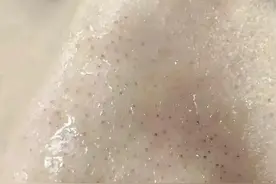 如何去黑头？图片