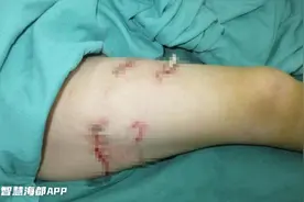 有医说医｜触目惊心！泉州5岁男童逗狗狗，反被咬伤10多处图片