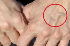 手臂“青筋暴起”的人，和几乎看不到青筋的人相比，哪种更健康？图片