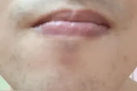 本人亲测脱毛仪脱胡须记录贴图片