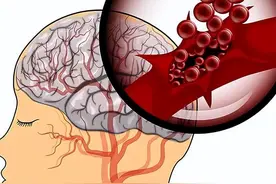 心梗、脑梗，血瘀阻滞？简单四味药，打通血管淤堵，缓解症状图片