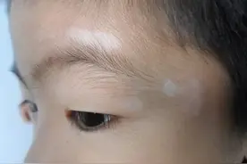 小孩身上为什么会长了白癜风，这几点因素要重视图片